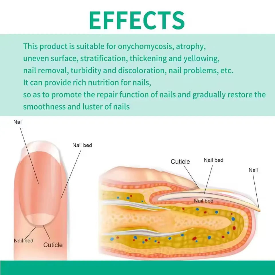 Nail Fungus Treatment Stop Fungal Growth Effective Fingernail 30ml