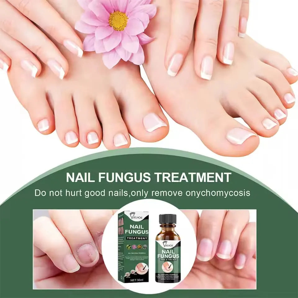 Nail Fungus Treatment Stop Fungal Growth Effective Fingernail 30ml