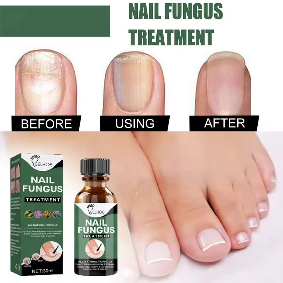 Nail Fungus Treatment Stop Fungal Growth Effective Fingernail 30ml