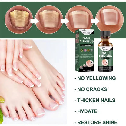 Nail Fungus Treatment Stop Fungal Growth Effective Fingernail 30ml